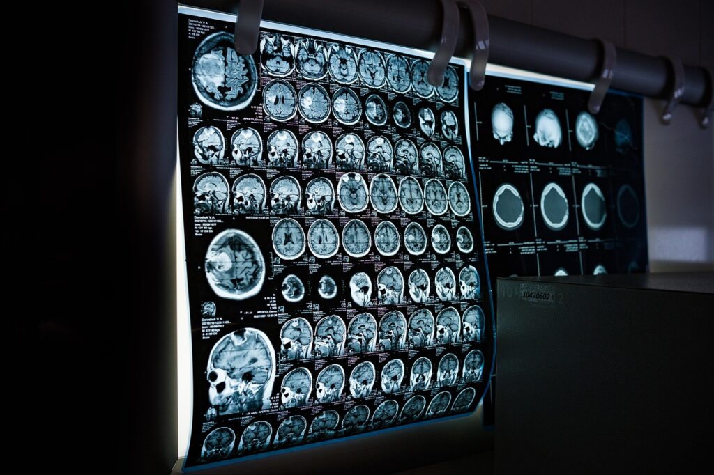 Ein Labor für Gehirntumor Forschung mit Monitor für Hirnscans und Bestrahlungsgerät im Hintergrund – Foto: Mitrey / Pixabay