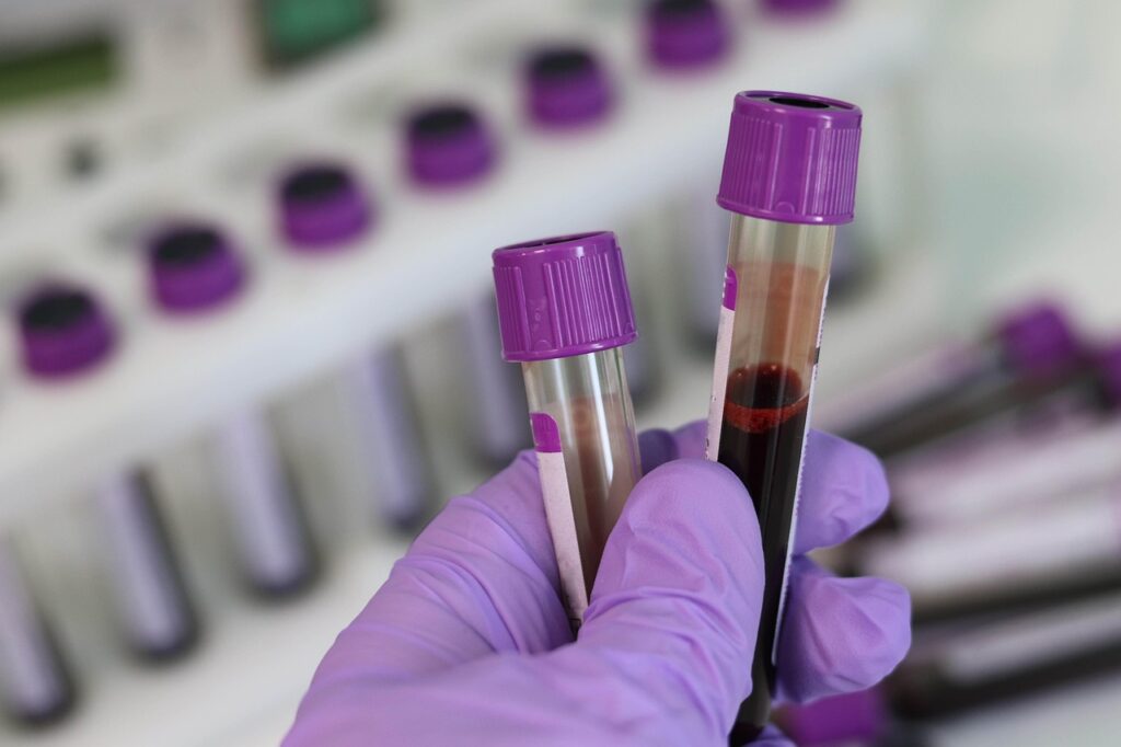 Laborarbeitsplatz mit Blutproben und Mikroskop symbolisiert die Forschung zum Thromboserisiko bei Hämolyse – Foto: Belova59 / Pixabay